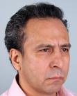 After Hair Transplant&nbsp;Front